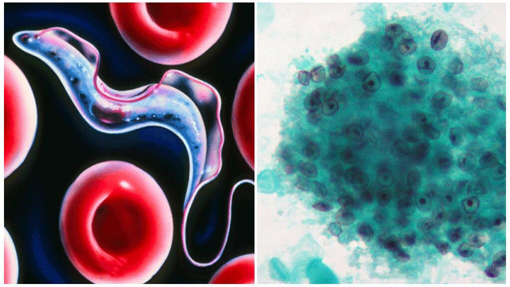 Pneumocisten im Körper